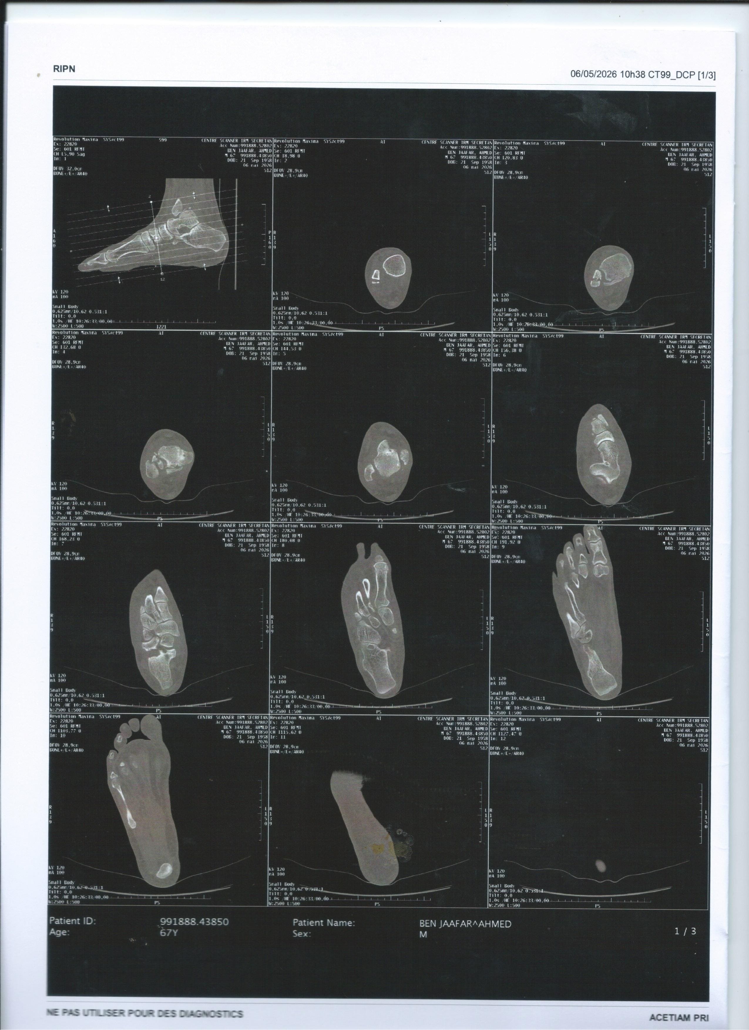 SCAN de la cheville droite