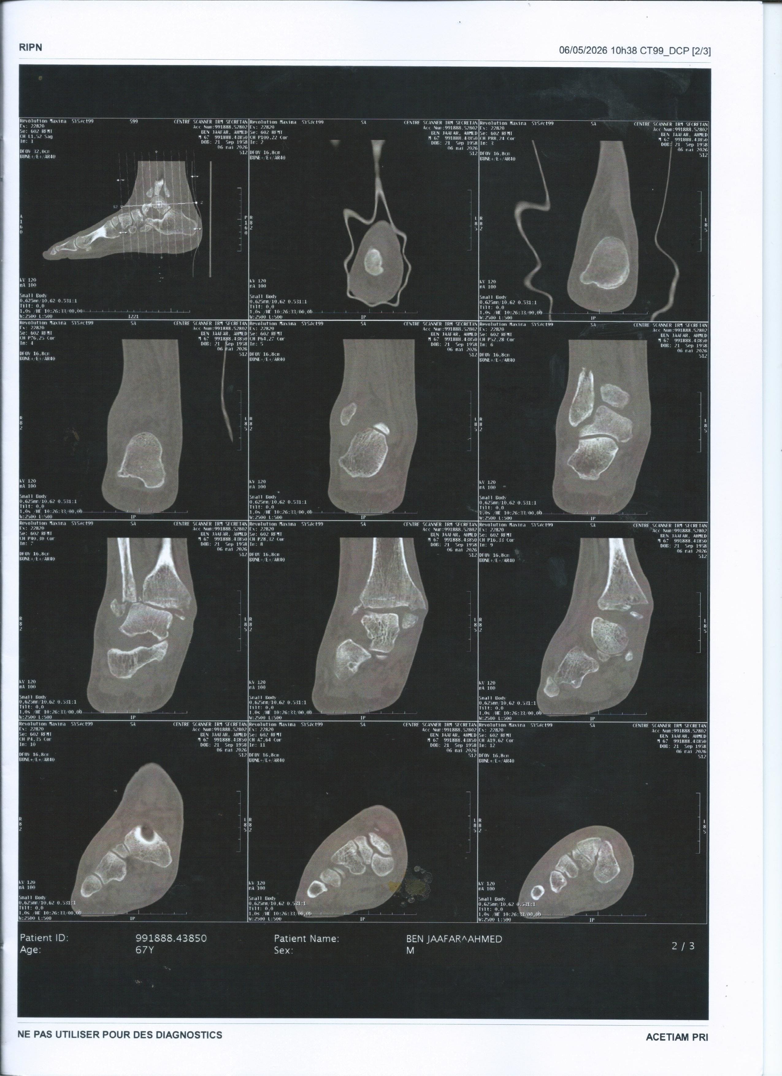 SCAN de la cheville droite
