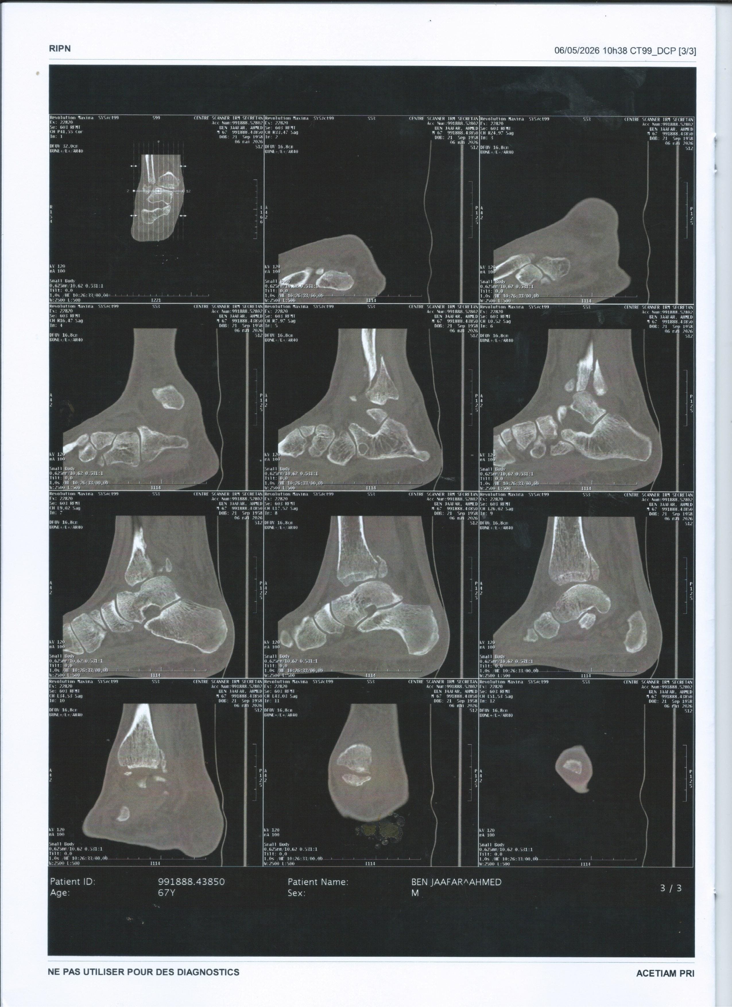 SCAN de la cheville droite